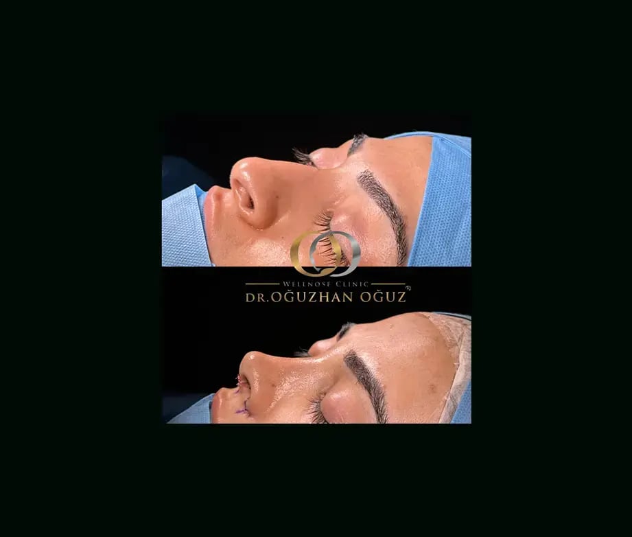oguzhan-oguz-md-rhinoplasty-before-after-20
