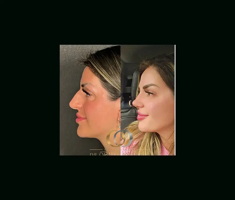 oguzhan-oguz-md-rhinoplasty-before-after-21