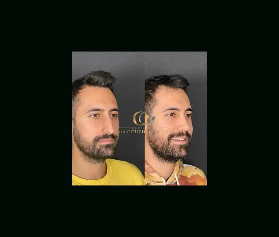 oguzhan-oguz-md-rhinoplasty-before-after-22