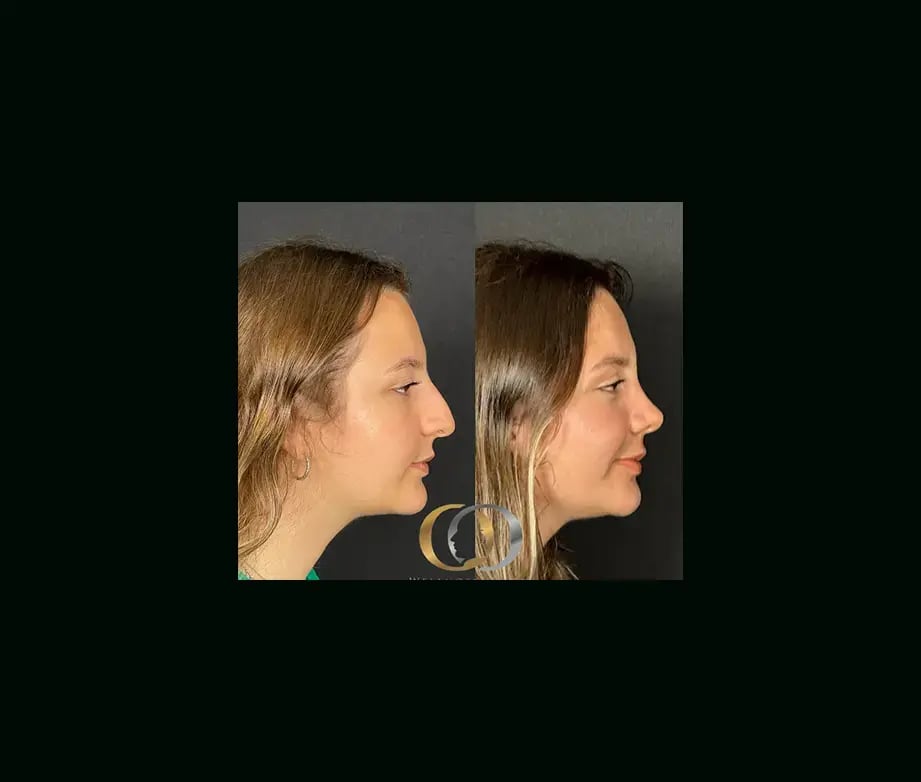 oguzhan-oguz-md-rhinoplasty-before-after-23