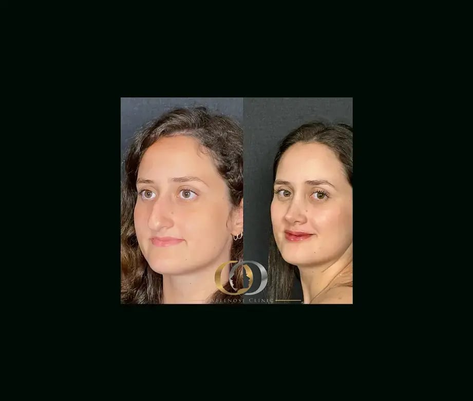 oguzhan-oguz-md-rhinoplasty-before-after-24