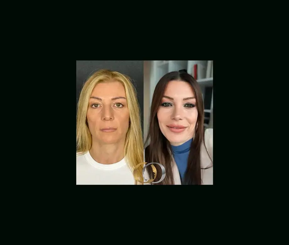 oguzhan-oguz-md-rhinoplasty-before-after-25