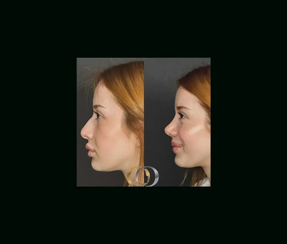 oguzhan-oguz-md-rhinoplasty-before-after-26