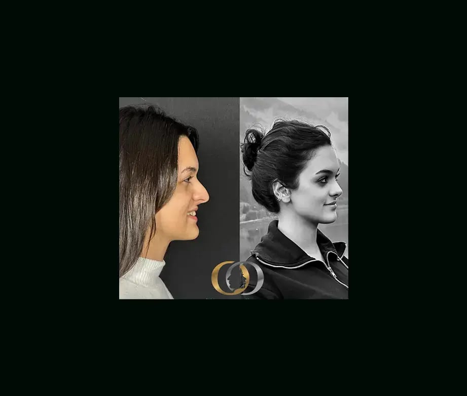 oguzhan-oguz-md-rhinoplasty-before-after-27
