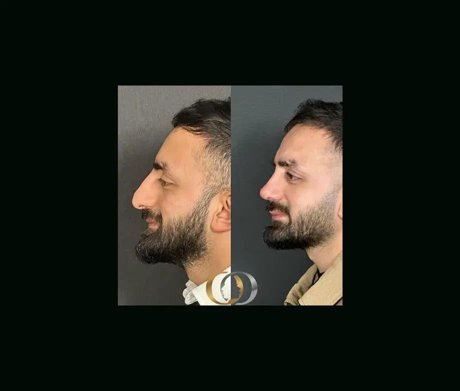 oguzhan-oguz-md-rhinoplasty-before-after-28