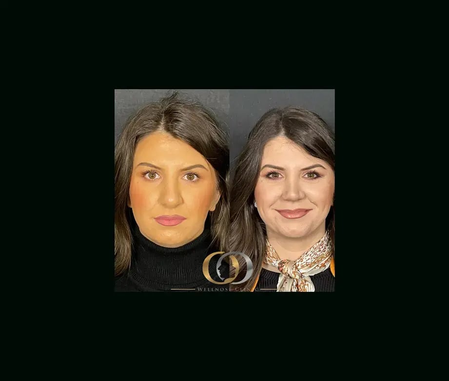 oguzhan-oguz-md-rhinoplasty-before-after-29