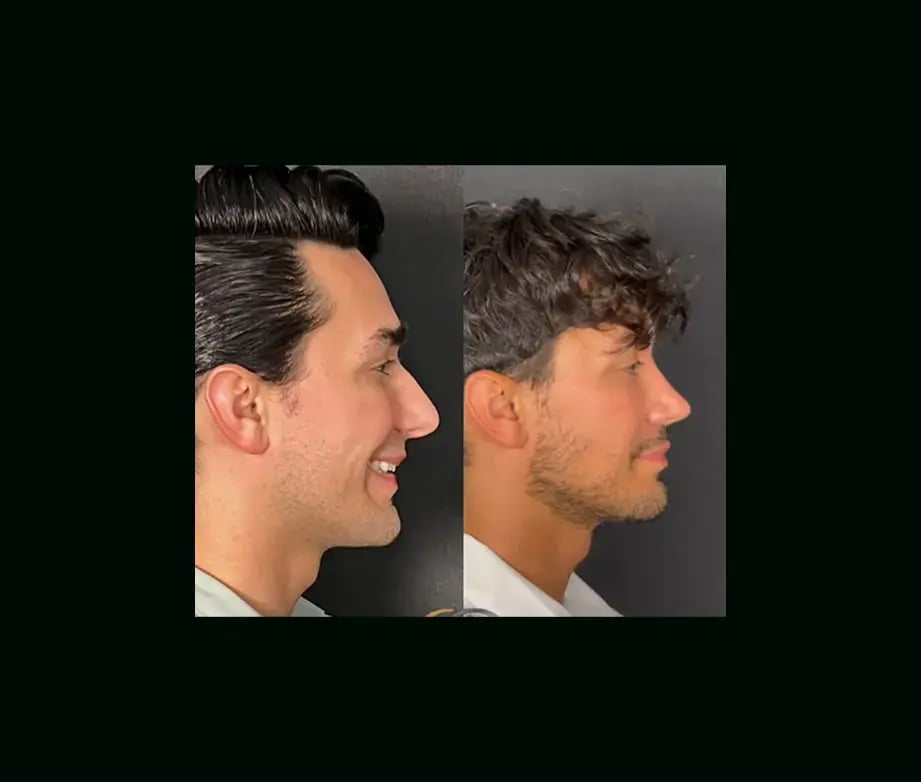 oguzhan-oguz-md-rhinoplasty-before-after-3-2