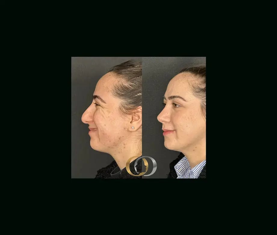 oguzhan-oguz-md-rhinoplasty-before-after-30