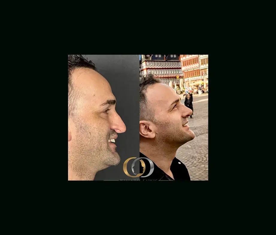 oguzhan-oguz-md-rhinoplasty-before-after-31