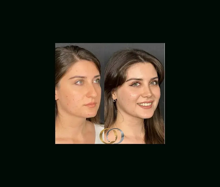 oguzhan-oguz-md-rhinoplasty-before-after-32-1