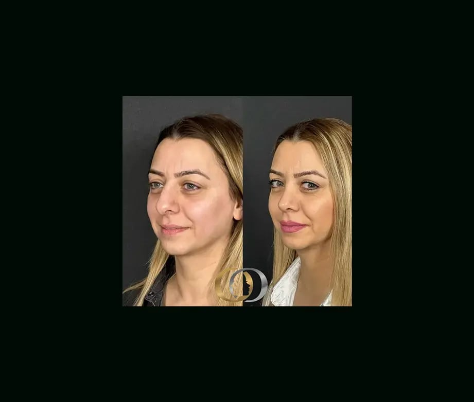 oguzhan-oguz-md-rhinoplasty-before-after-33