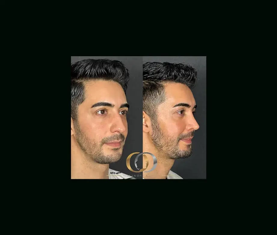 oguzhan-oguz-md-rhinoplasty-before-after-34