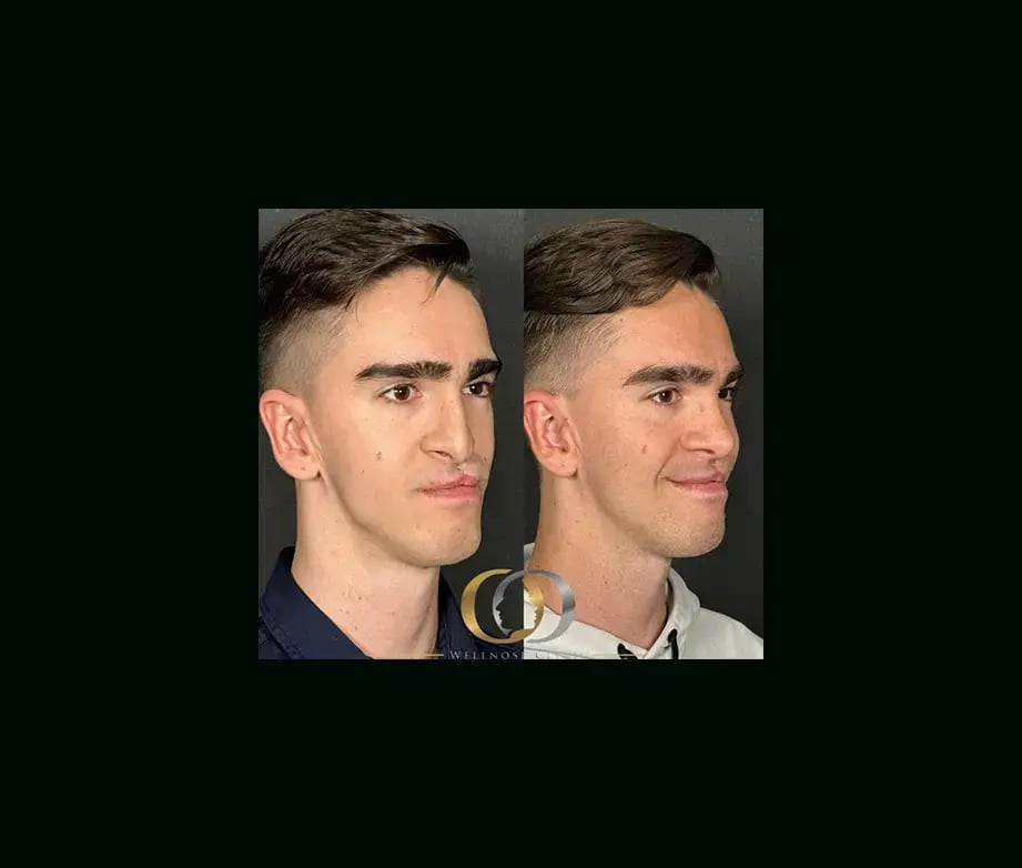 oguzhan-oguz-md-rhinoplasty-before-after-35