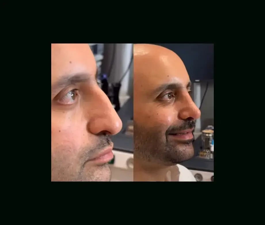 oguzhan-oguz-md-rhinoplasty-before-after-4-1