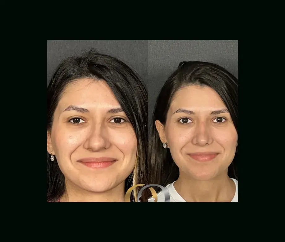 oguzhan-oguz-md-rhinoplasty-before-after-5-1