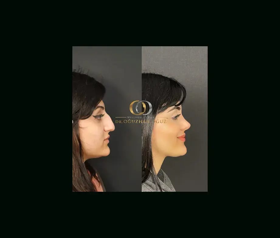 oguzhan-oguz-md-rhinoplasty-before-after-6