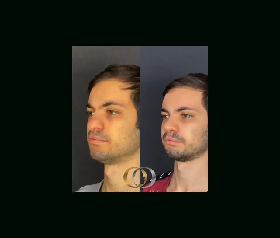 oguzhan-oguz-md-rhinoplasty-before-after-7