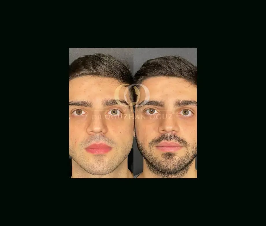 oguzhan-oguz-md-rhinoplasty-before-after-8
