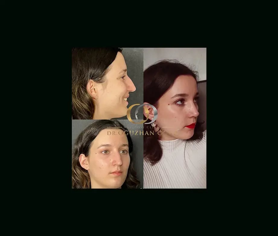 oguzhan-oguz-md-rhinoplasty-before-after-9
