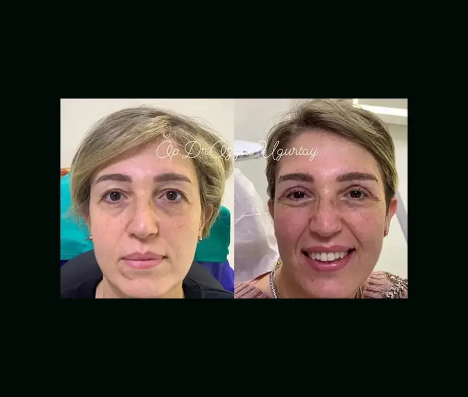 ozgul-ugurtay-md-eyelid-before-after-1