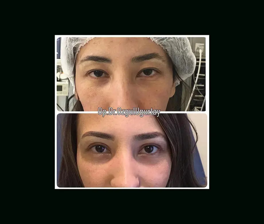 ozgul-ugurtay-md-eyelid-before-after-2