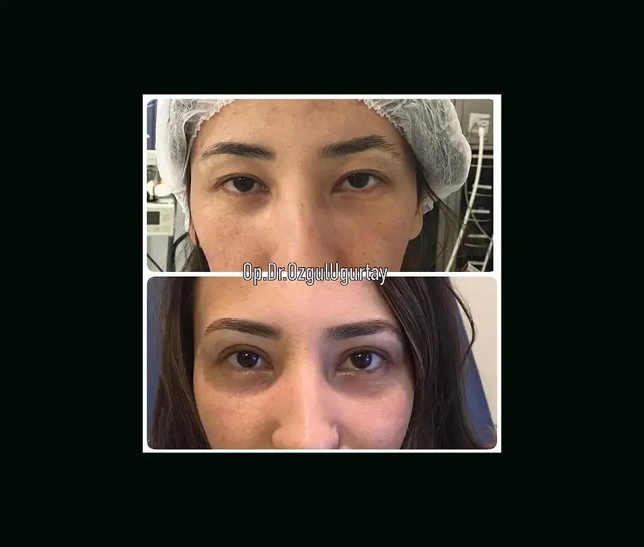 ozgul-ugurtay-md-eyelid-before-after-3