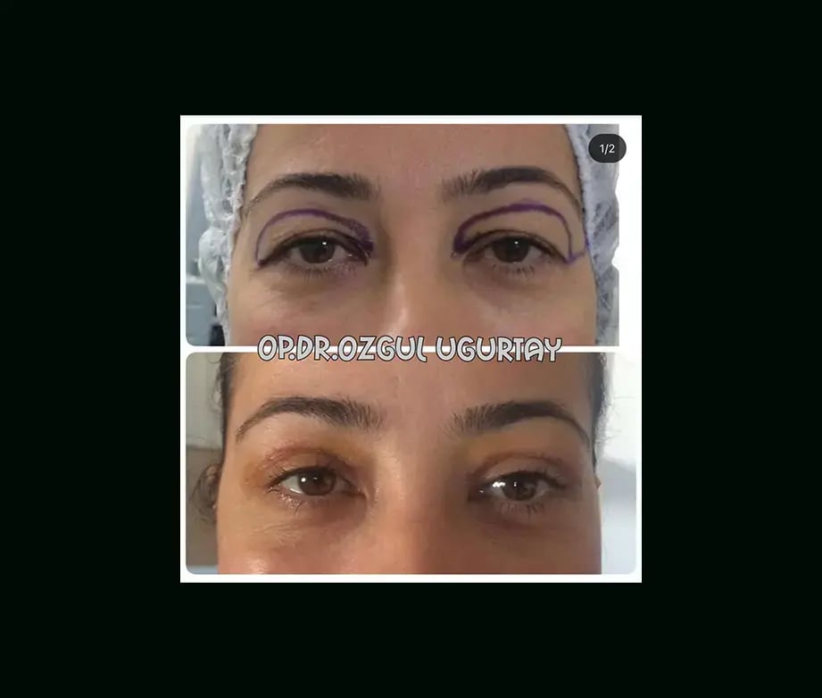ozgul-ugurtay-md-eyelid-before-after-4