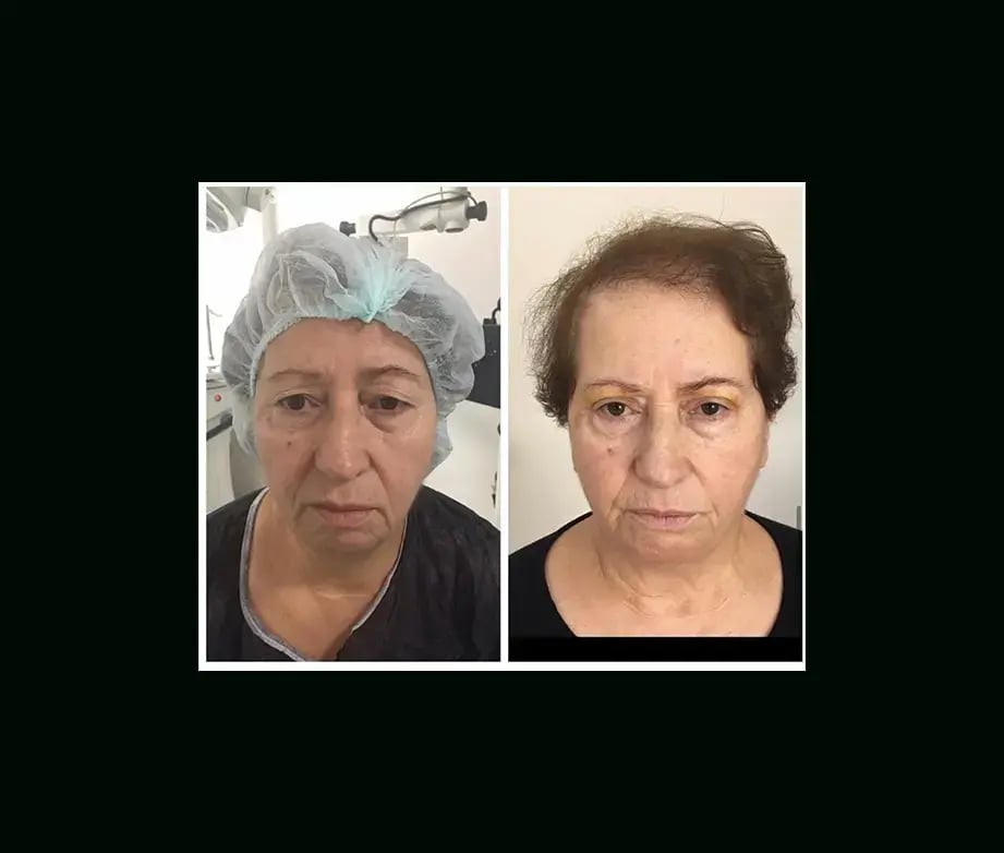 ozgul-ugurtay-md-eyelid-before-after-9