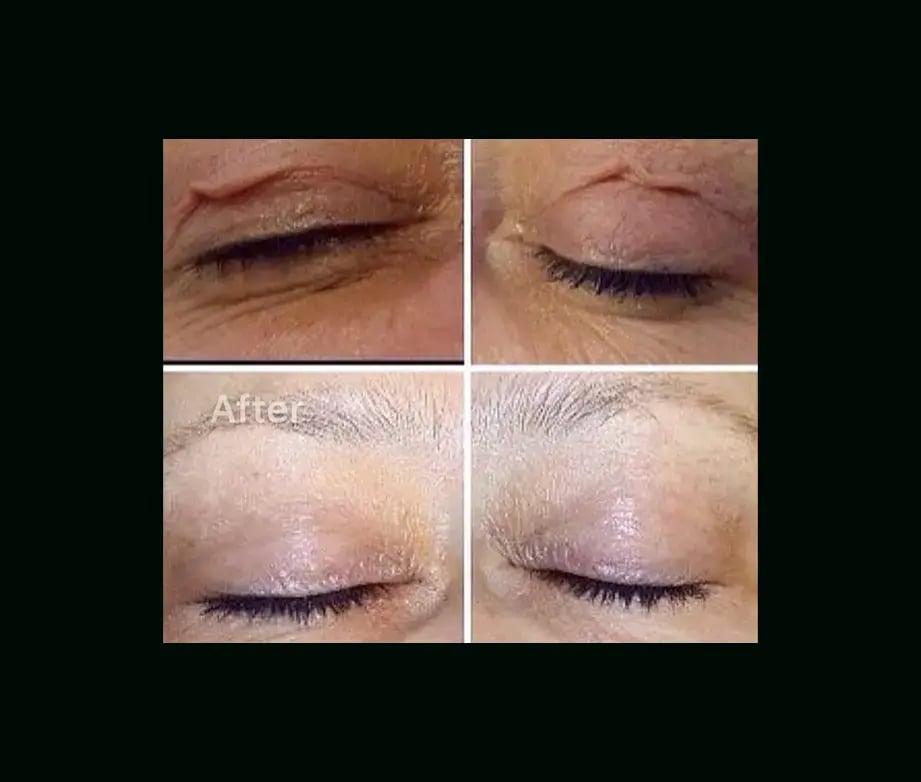 serhat-tuncer-md-eyelid-before-after-1-1