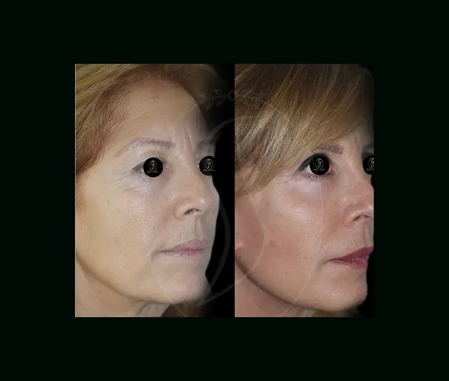 serhat-tuncer-md-face-lift-before-after-1-2