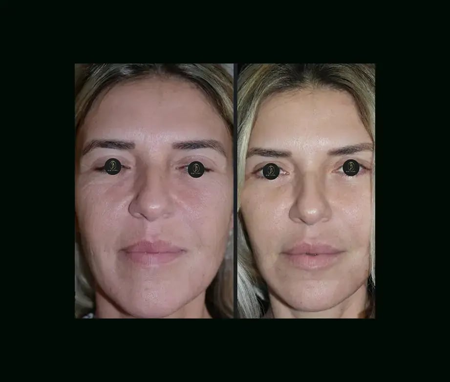 serhat-tuncer-md-face-lift-before-after-2-2