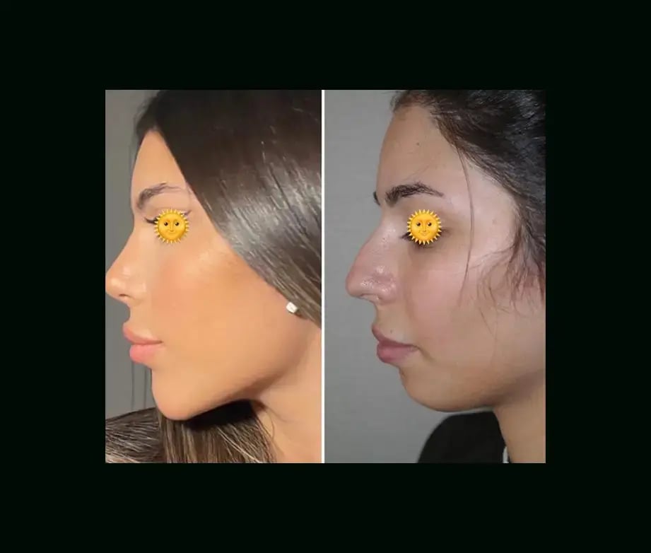 serhat-tuncer-md-rhinoplasty-before-after-1-1