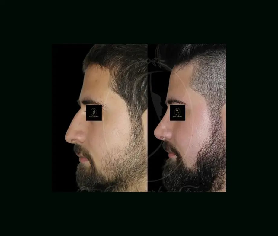 serhat-tuncer-md-rhinoplasty-before-after-2-1