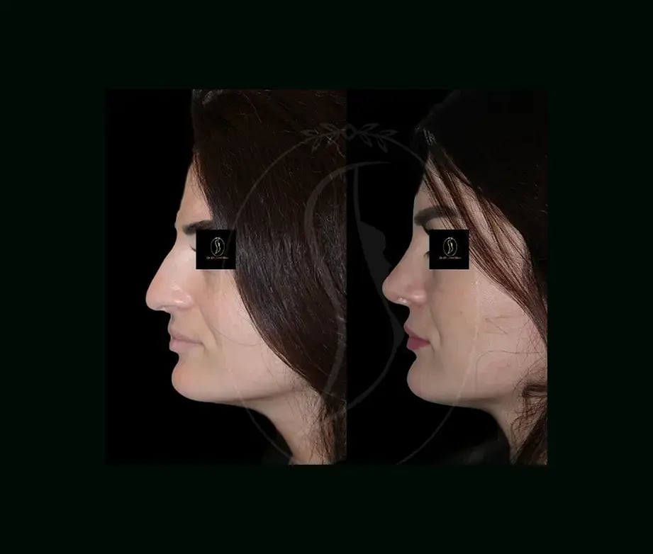 serhat-tuncer-md-rhinoplasty-before-after-3-1