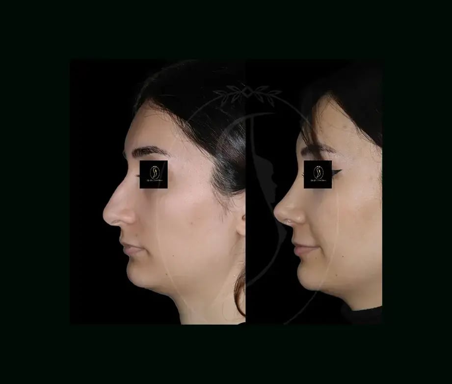 serhat-tuncer-md-rhinoplasty-before-after-4-1