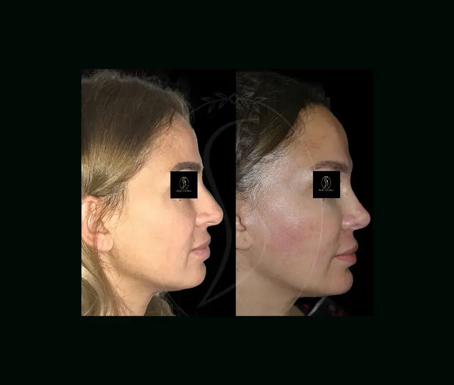 serhat-tuncer-md-rhinoplasty-before-after-5-1