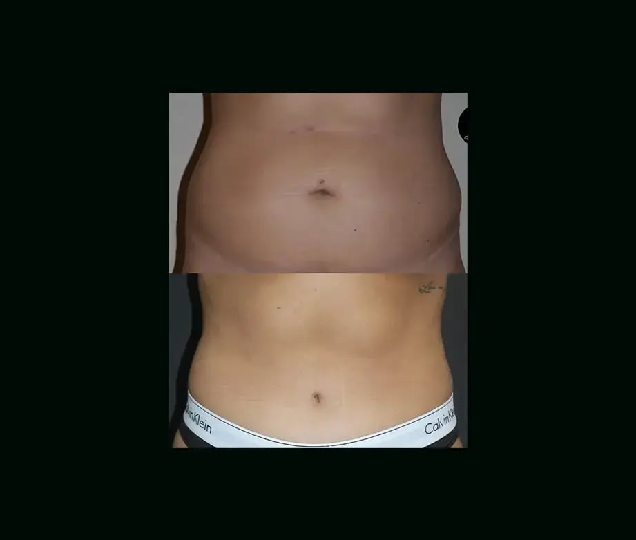 serhat-tuncer-md-tummy-tuck-before-after-1-2