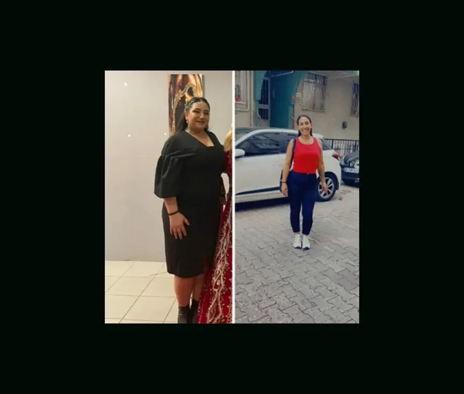 taalaibek-sydkov-md-gastirc-sleeve-before-after-1