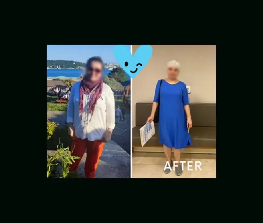 taalaibek-sydkov-md-gastirc-sleeve-before-after-3
