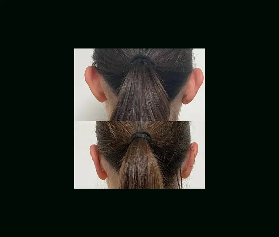 tayfun-demirel-md-ear-surgery-before-after-1-1