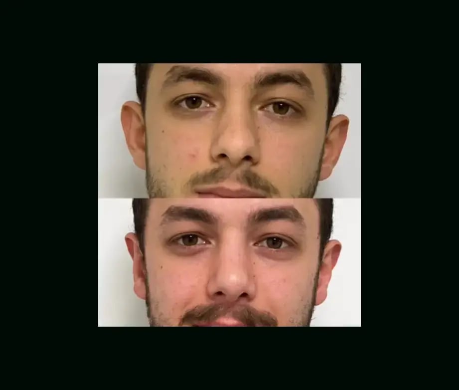 tayfun-demirel-md-ear-surgery-before-after-2