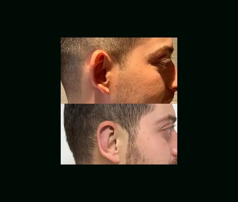 tayfun-demirel-md-ear-surgery-before-after-3-1
