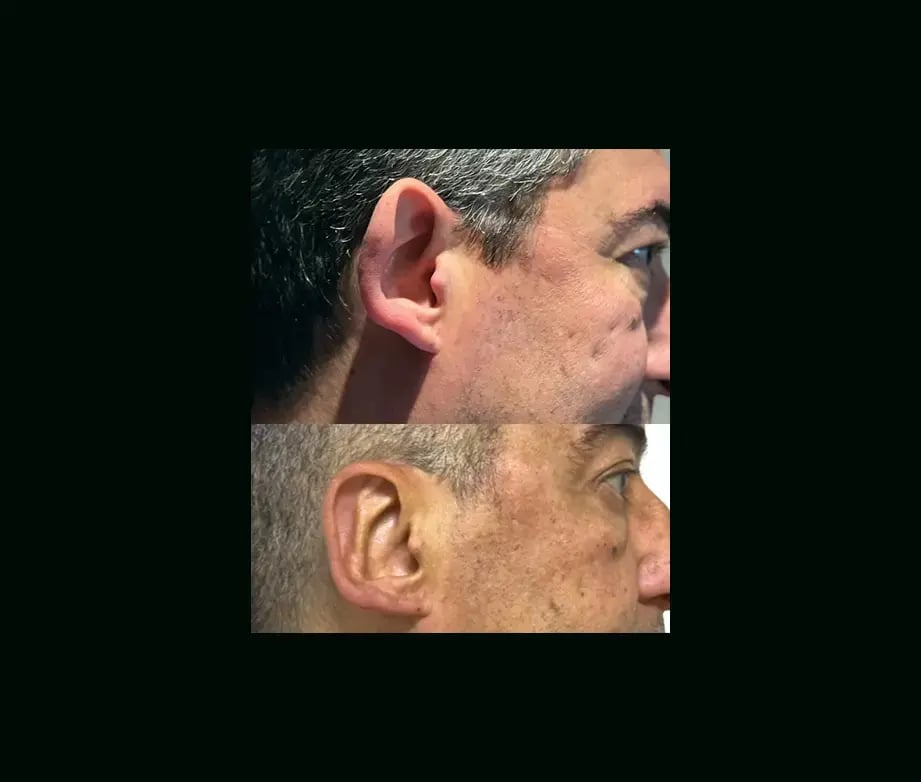 tayfun-demirel-md-ear-surgery-before-after-4-1