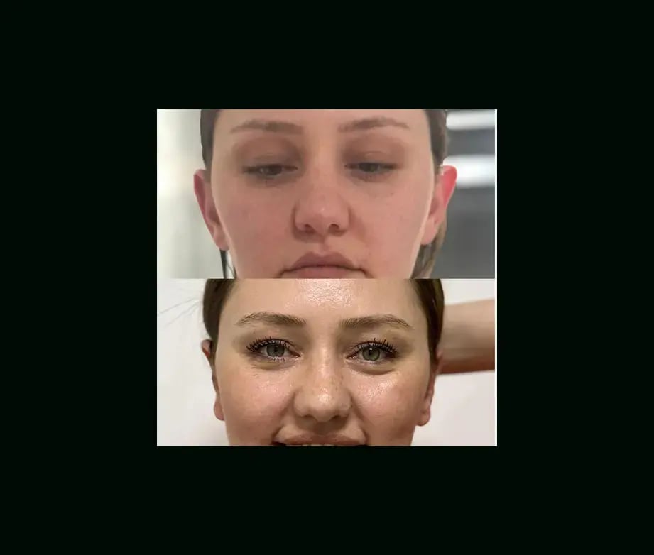 tayfun-demirel-md-ear-surgery-before-after-5