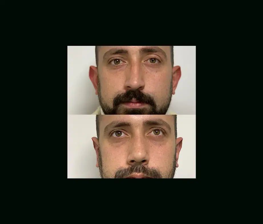 tayfun-demirel-md-ear-surgery-before-after-6