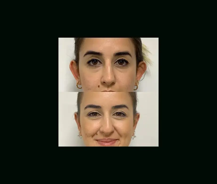 tayfun-demirel-md-ear-surgery-before-after-7-1