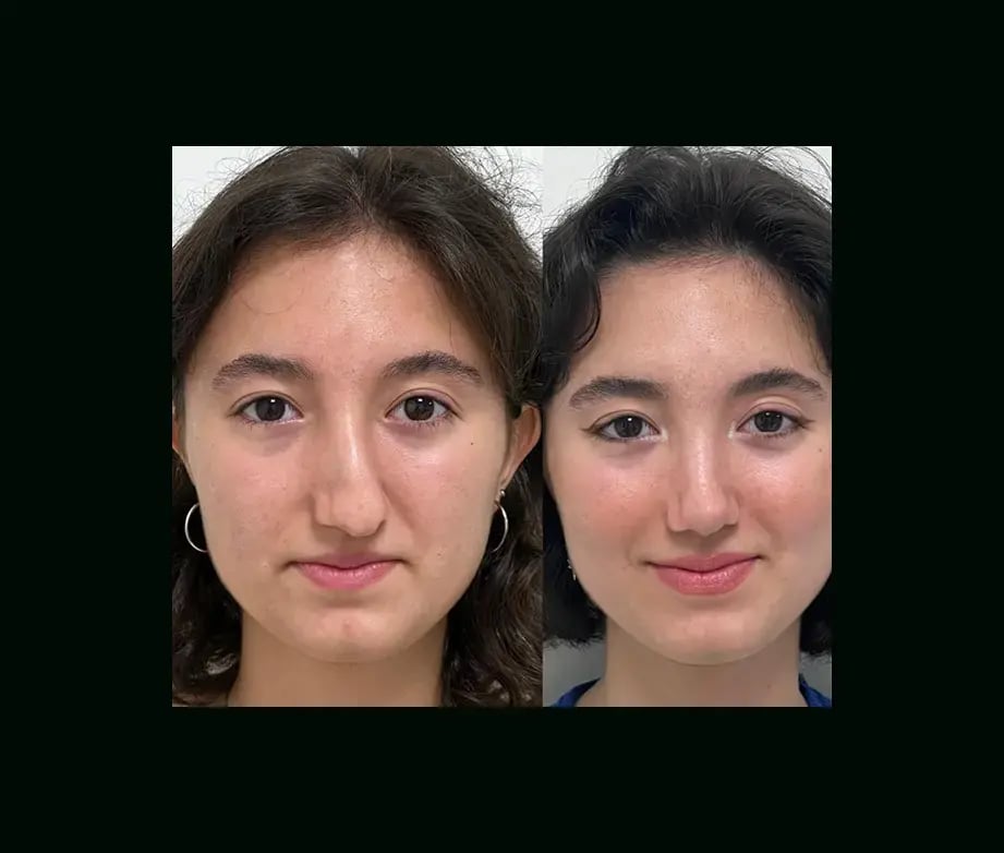 tayfun-demirel-md-rhinoplasty-before-after-1-1