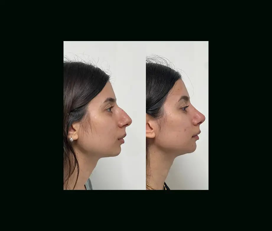 tayfun-demirel-md-rhinoplasty-before-after-10