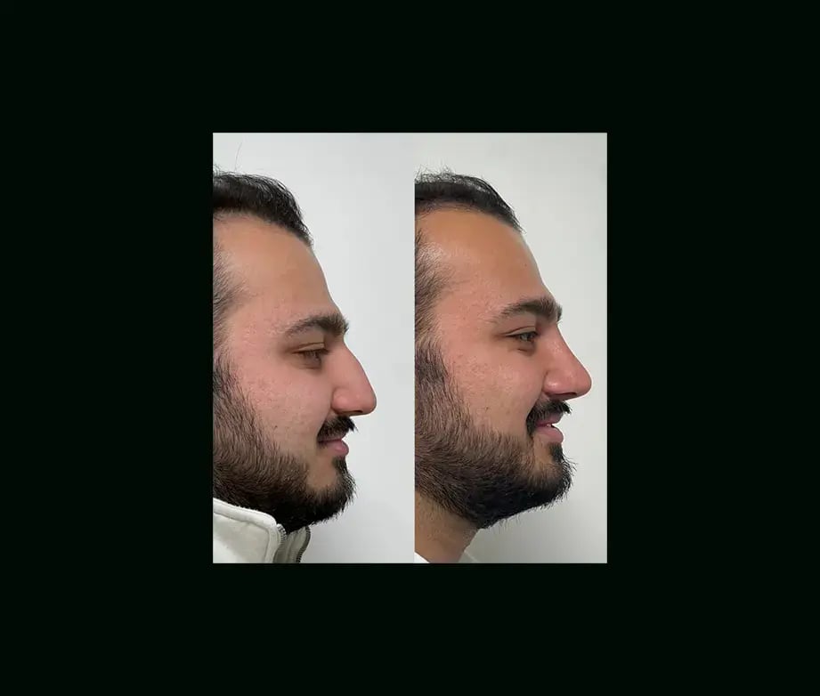 tayfun-demirel-md-rhinoplasty-before-after-11
