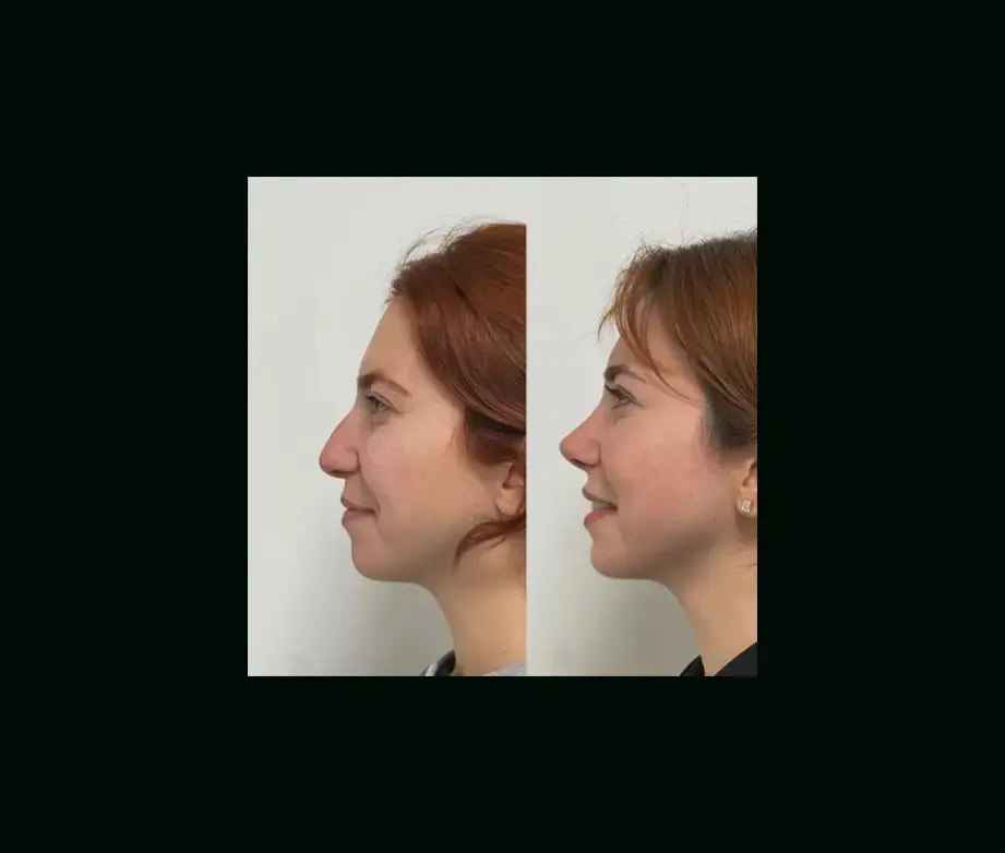 tayfun-demirel-md-rhinoplasty-before-after-12